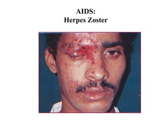 AIDS:
Herpes Zoster
 