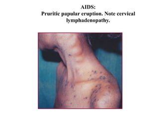AIDS:
Pruritic papular eruption. Note cervical
lymphadenopathy.
 