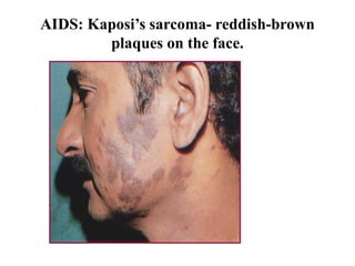 AIDS: Kaposi’s sarcoma- reddish-brown
plaques on the face.
 
