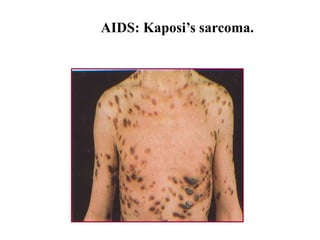 AIDS: Kaposi’s sarcoma.
 