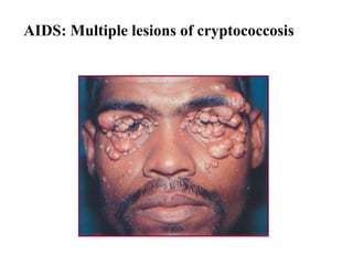 AIDS: Multiple lesions of cryptococcosis
 