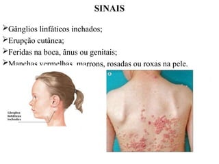 SINAIS
Gânglios linfáticos inchados;
Erupção cutânea;
Feridas na boca, ânus ou genitais;
Manchas vermelhas, marrons, rosadas ou roxas na pele.
 