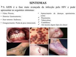 SINTOMAS
• Febre: Pirexia;
• Diarreia: Gastroenterite;
• Suor noturno: Sudorese;
• Emagrecimento: Perda de peso intencional..
A AIDS é a fase mais avançada da infecção pelo HIV e pode
apresentar os seguintes sintomas:
• Aparecimento de doenças oportunistas
como:
 Pneumonia;
 Tuberculose;
 Candidíase;
 Até mesmo alguns tipos de câncer
 