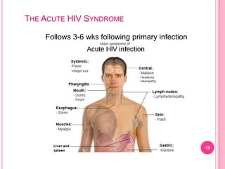 18
THE ACUTE HIV SYNDROME
Follows 3-6 wks following primary infection
 