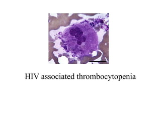 HIV associated thrombocytopenia
 