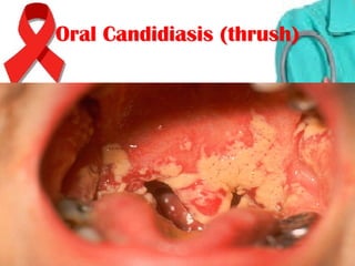 Oral Candidiasis (thrush)Oral Candidiasis (thrush)
 