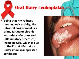 Oral Hairy LeukoplakiaOral Hairy Leukoplakia
Being that HIV reduces Being that HIV reduces 
immunologic activity, the immunologic activity, the 
intraoral environment is a intraoral environment is a 
prime target for chronic prime target for chronic 
secondary infections and secondary infections and 
inflammatory processes, inflammatory processes, 
including OHL, which is due including OHL, which is due 
to the Epstein-Barr virus to the Epstein-Barr virus 
under immunosuppressed under immunosuppressed 
conditions conditions 
 