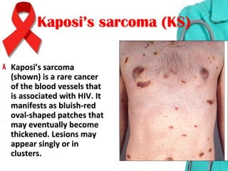Kaposi’s sarcoma (KS)Kaposi’s sarcoma (KS)
Kaposi’s sarcoma Kaposi’s sarcoma 
(shown) is a rare cancer (shown) is a rare cancer 
of the blood vessels that of the blood vessels that 
is associated with HIV. It is associated with HIV. It 
manifests as bluish-red manifests as bluish-red 
oval-shaped patches that oval-shaped patches that 
may eventually become may eventually become 
thickened. Lesions may thickened. Lesions may 
appear singly or in appear singly or in 
clusters. clusters. 
 
