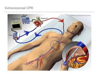 Extracorporeal CPR
 