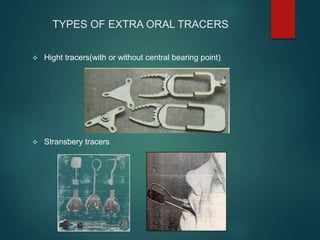 TYPES OF EXTRA ORAL TRACERS
 Hight tracers(with or without central bearing point)
 Stransbery tracers
 