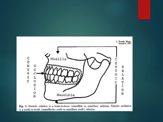 METHODS TO RETRUDE THE MANDIBLE
WHILE RECORDING CR
RELAXATION OF JAW:
 Simplest, easiest and most efficient way of causin...