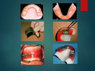 FUNCTIONAL METHOD
 These methods utilize the functional movements of the
jaws to record the centric relation.
The patient...