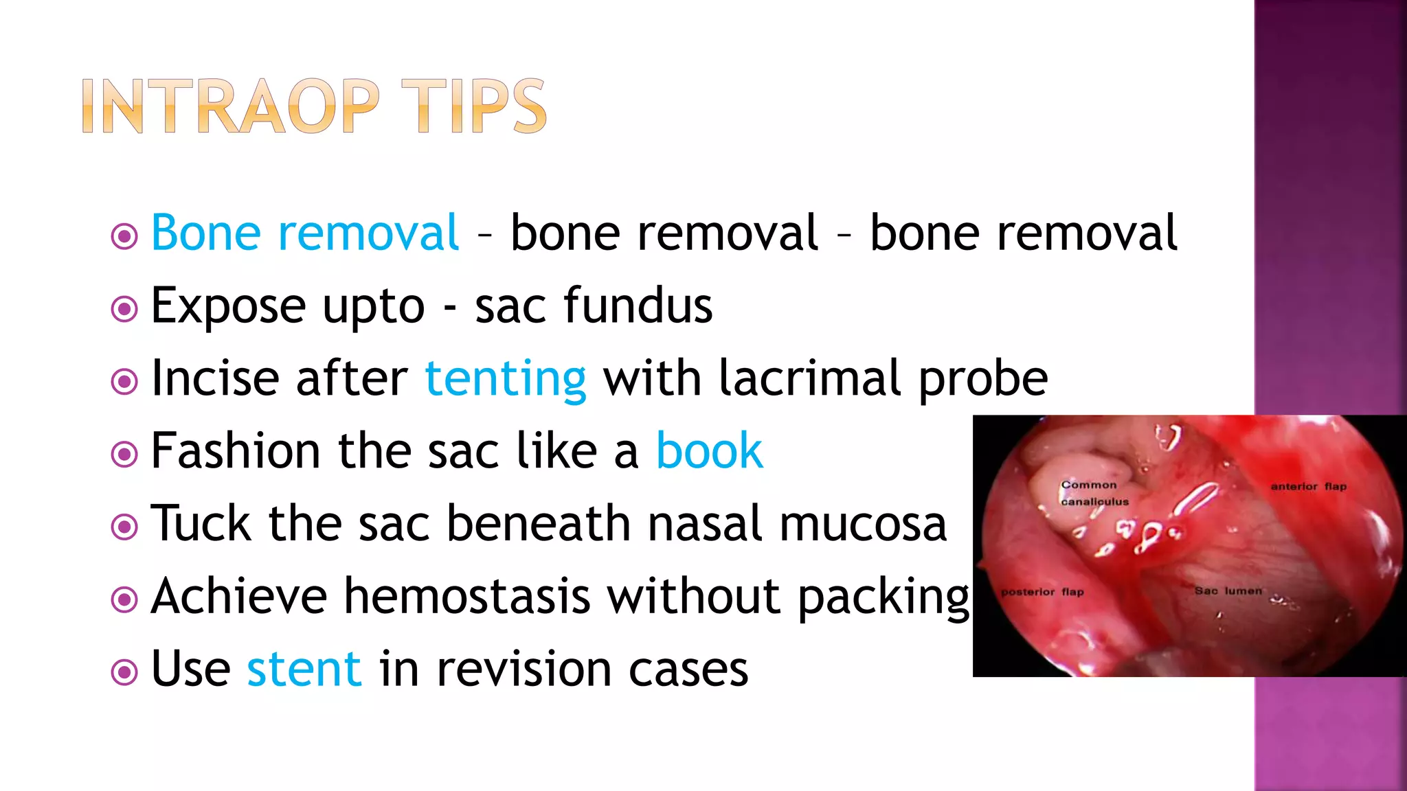  Bone removal – bone removal – bone removal
Expose upto - sac fundus
Incise after tenting with lacrimal probe
Fashion the sac like a book
Tuck the sac beneath nasal mucosa
Achieve hemostasis without packing
Use stent in revision cases