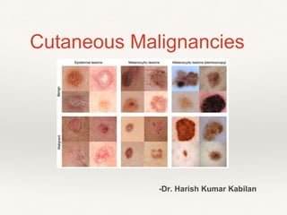 Cutaneous Malignancies
-Dr. Harish Kumar Kabilan
 
