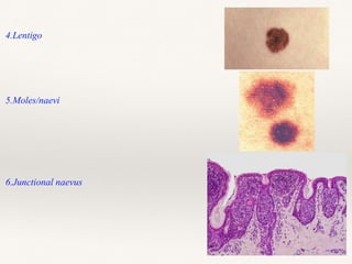 4.Lentigo
5.Moles/naevi
6.Junctional naevus
 