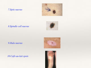 7.Spitz naevus
8.Spindle cell naevus
9.Halo naevus
10.Café-au-lait spots
 