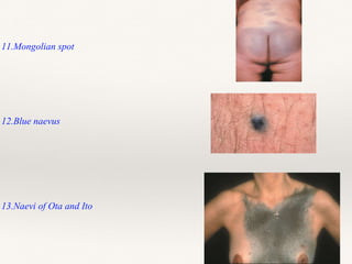 11.Mongolian spot
12.Blue naevus
13.Naevi of Ota and Ito
 