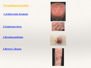 Premalignant lesions
1.Actinic/solar keratosis
3.Keratoacanthoma
4.Bowen’s disease
.
2.Cutaneous horn
 