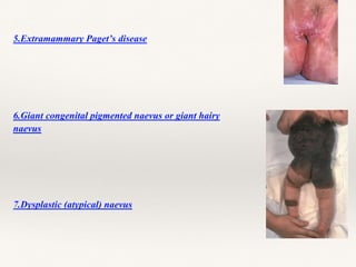 5.Extramammary Paget’s disease
6.Giant congenital pigmented naevus or giant hairy
naevus
7.Dysplastic (atypical) naevus
 