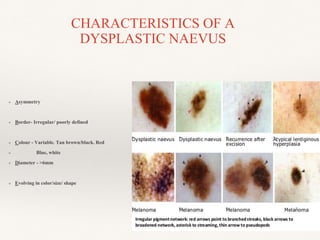 CHARACTERISTICS OF A
DYSPLASTIC NAEVUS
❖ Asymmetry
❖ Border- Irregular/ poorly defined
❖ Colour - Variable. Tan brown/black. Red
❖ Blue, white
❖ Diameter - >6mm
❖ Evolving in color/size/ shape
 