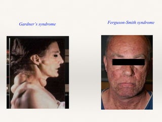 Gardner’s syndrome Ferguson-Smith syndrome
 