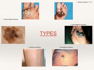 3. Lentigo maligna melanoma:
TYPES
2. Nodular melanoma: 12-25%.
4. Acral lentiginous melanoma:
6. Desmoplastic melanoma5. Amelanotic melanoma:
 
