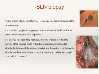 A vital blue dye (e.g., isosulfan blue) is injected into the dermis around the
melanoma site.
It is combined lymphatic mapping technique allows for the identification
of the sentinel nodes in 99% of patients
It is injected just before the operation. it is best to inject it within the
margins of the planned WLE. A hand-held gamma probe is used to
identify the location of the sentinel node(s), and dissection is performed to
identify blue lymphatic channels entering into a blue, radioactive lymph
node, which is removed
SLN biopsy
 