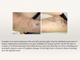 Examples of in-transit melanoma of the arm (left) and leg (right). Note the distribution and extent of
disease, making these presentations very poor candidates for surgical excision. On the left, there is
evidence of in-transit metastases both within the area of previous skin flap, as well as extending more
proximally along its course of lymphatic drainage. On the right, there is extensive disease extending
up to the inguinal crease.
 