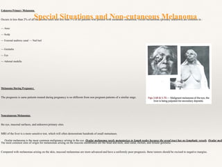 Unknown Primary Melanoma
Occurs in less than 2% of all melanoma cases and less than 5% of all patients who present with metastatic melanoma. Occult melanomas (primary unknown) are common in :
— Anus
— Scalp
— External auditory canal — Nail bed
— Genitalia
— Eye
— Adrenal medulla
Melanoma During Pregnancy
The prognosis is same patients treated during pregnancy is no different from non pregnant patients of a similar stage.
Noncutaneous Melanomas
the eye, mucosal surfaces, and unknown primary sites.
MRI of the liver is a more sensitive test, which will often demonstrate hundreds of small metastases.
The most common sites of origin for melanomas arising on the mucous membranes are the head and neck, anal canal, rectum, and female genitalia.
Compared with melanomas arising on the skin, mucosal melanomas are more advanced and have a uniformly poor prognosis. these tumors should be excised to negative margins.
Special Situations and Non-cutaneous Melanoma
Ocular melanoma is the most common malignancy arising in the eye. Ocular melanoma rarely metastasizes to lymph nodes because the uveal tract has no lymphatic vessels. Ocular mela
 