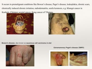It occurs in premalignant conditions like Bowen’s disease, Paget’s disease, leukoplakia, chronic scars,
chemically induced chronic irritation, radiodermatitis, senile keratosis, e.g. Khangri cancer in
Kashmir, Chimney scrotal cancer, Kang cancer of Tibetans.
Bowen's disease, also known as squamous cell carcinoma in situ[
Extramammary Paget’s disease (EMPD)
 