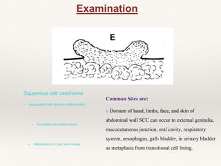 Examination
Squamous cell carcinoma
▪ Associated with chronic inflammation
▪ Invariably ulcerated lesion
▪ Metastasis in 2 per cent cases
Common Sites are:
o Dorsum of hand, limbs, face, and skin of
abdominal wall SCC can occur in external genitalia,
mucocutaneous junction, oral cavity, respiratory
system, oesophagus, gall- bladder, in urinary bladder
as metaplasia from transitional cell lining.
 