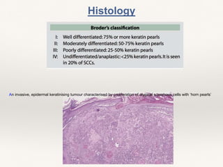 Histology
An invasive, epidermal keratinising tumour characterised by proliferation of atypical squamous cells with ‘horn pearls’
 