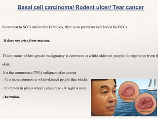 In contrast to SCCs and actinic keratoses, there is no precursor skin lesion for BCCs.
Basal cell carcinoma/ Rodent ulcer/ Tear cancer
This tumour of low-grade malignancy is common in white-skinned people. It originates from th
skin.
It does not arise from mucosa.
It is the commonest (70%) malignant skin tumour.
o It is more common in white-skinned people than blacks.
o Common in places where exposure to UV light is more
(Australia).
 