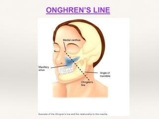 ONGHREN’S LINE
 