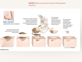 MOHS (Microscopically Oriented Histographic
Surgery)
 