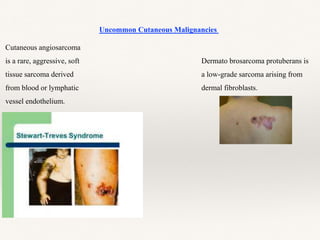 Uncommon Cutaneous Malignancies
Cutaneous angiosarcoma
is a rare, aggressive, soft
tissue sarcoma derived
from blood or lymphatic
vessel endothelium.
Dermato brosarcoma protuberans is
a low-grade sarcoma arising from
dermal fibroblasts.
 