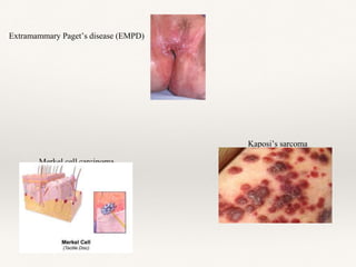 Extramammary Paget’s disease (EMPD)
Kaposi’s sarcoma
Merkel cell carcinoma
 