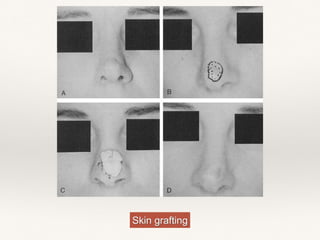 Skin grafting
 