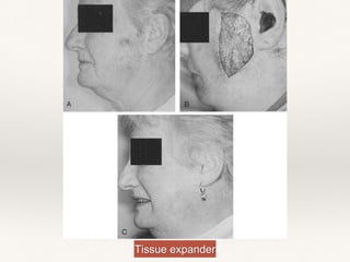 Tissue expander
 