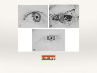 Local flap
 