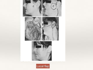 Local flap
 