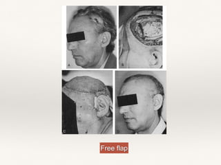 Free flap
 