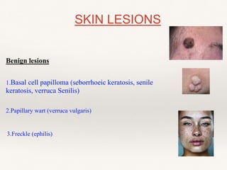 Benign lesions
1.Basal cell papilloma (seborrhoeic keratosis, senile
keratosis, verruca Senilis)
2.Papillary wart (verruca vulgaris)
SKIN LESIONS
3.Freckle (ephilis)
 