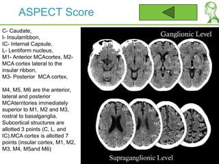 ASPECT Score
C- Caudate,
I- Insularribbon,
IC- Internal Capsule,
L- Lentiform nucleus,
M1- Anterior MCAcortex, M2-
MCA cortex lateral to the
insular ribbon,
M3- Posterior MCA cortex,
M4, M5, M6 are the anterior,
lateral and posterior
MCAterritories immediately
superior to M1, M2 and M3,
rostral to basalganglia.
Subcortical structures are
allotted 3 points (C, L, and
IC).MCA cortex is allotted 7
points (insular cortex, M1, M2,
M3, M4, M5and M6)
 