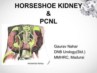 HORSESHOE KIDNEY
&
PCNL
Gaurav Nahar
DNB Urology(Std.)
MMHRC, Madurai
 