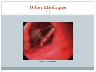 Other Etiologies
Lower 3rd of esophagus
 