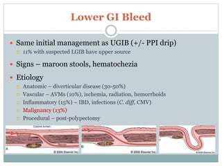 Lower GI Bleed
 Same initial management as UGIB (+/- PPI drip)
 11% with suspected LGIB have upper source
 Signs – maroon stools, hematochezia
 Etiology
 Anatomic – diverticular disease (30-50%)
 Vascular – AVMs (10%), ischemia, radiation, hemorrhoids
 Inflammatory (15%) – IBD, infections (C. diff, CMV)
 Malignancy (13%)
 Procedural – post-polypectomy
 