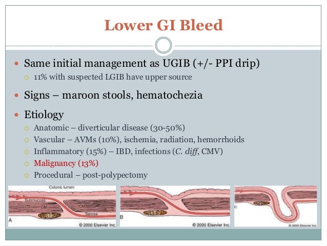 Gi bleed
