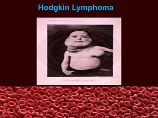 Hodgkin Lymphoma
 