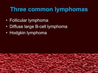 Three common lymphomas
• Follicular lymphoma
• Diffuse large B-cell lymphoma
• Hodgkin lymphoma
 